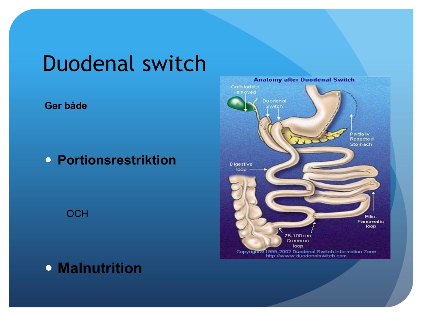 Duodenal switch Ger både Portionsrestriktion OCH Malnutrition