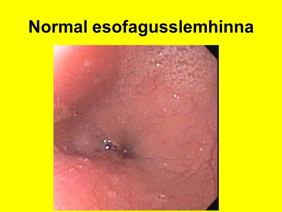 Normal esofagusslemhinna