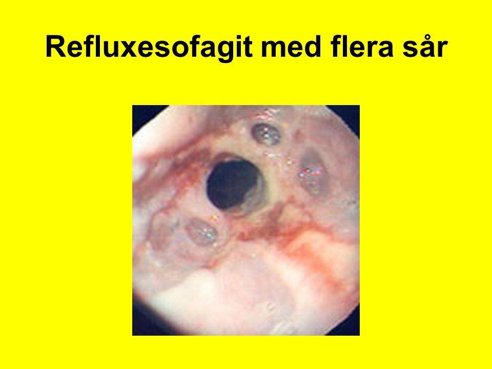 Refluxesofagit med flera sår
