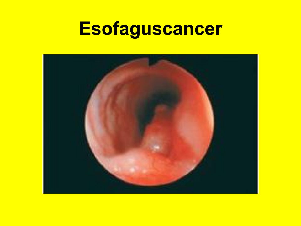 Esofaguscancer