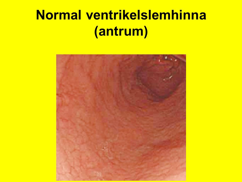Normal ventrikelslemhinna (antrum)
