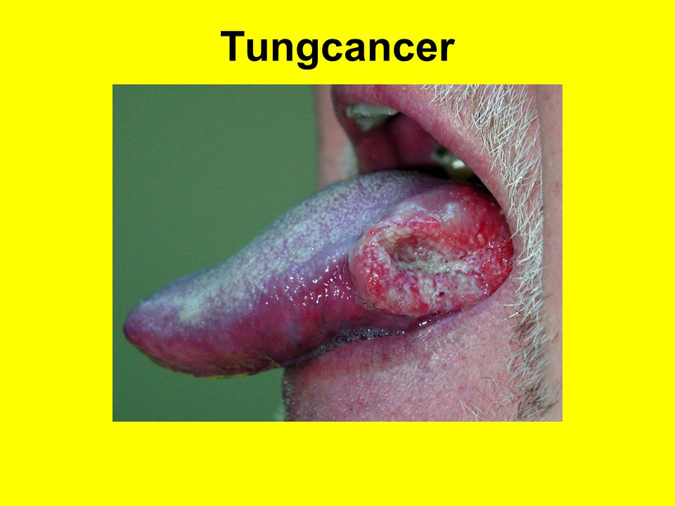 Tungcancer
