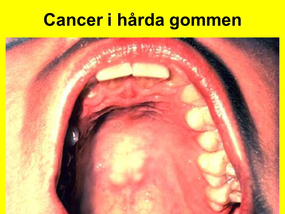 Cancer i hårda gommen