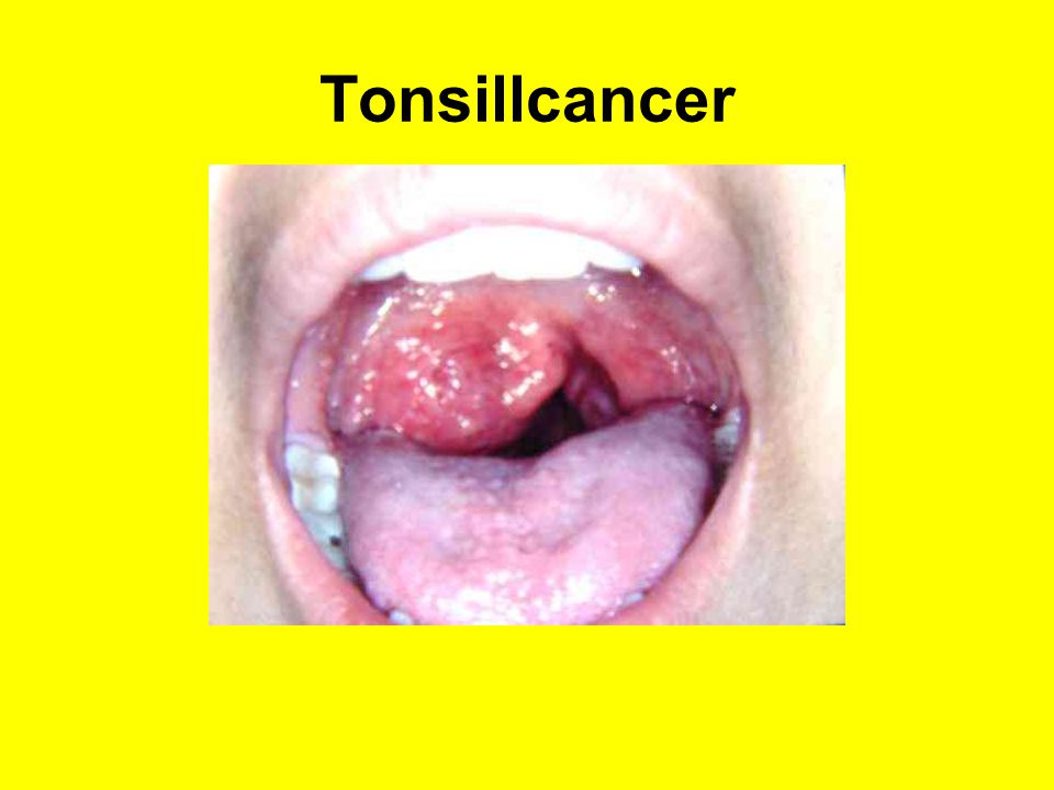 Tonsillcancer