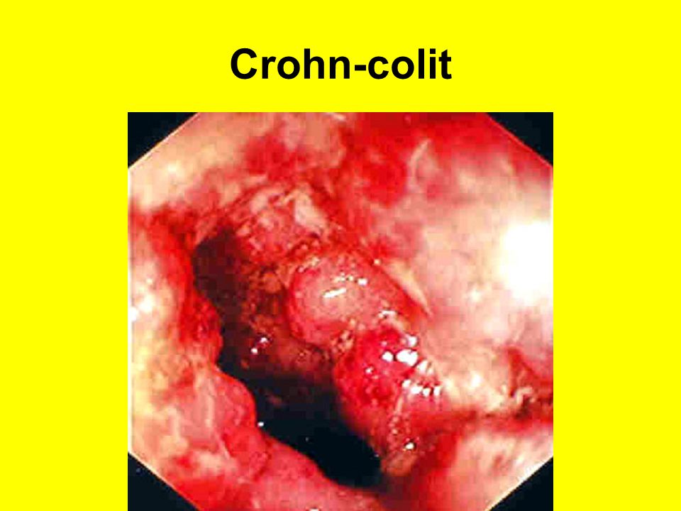 Crohn-colit
