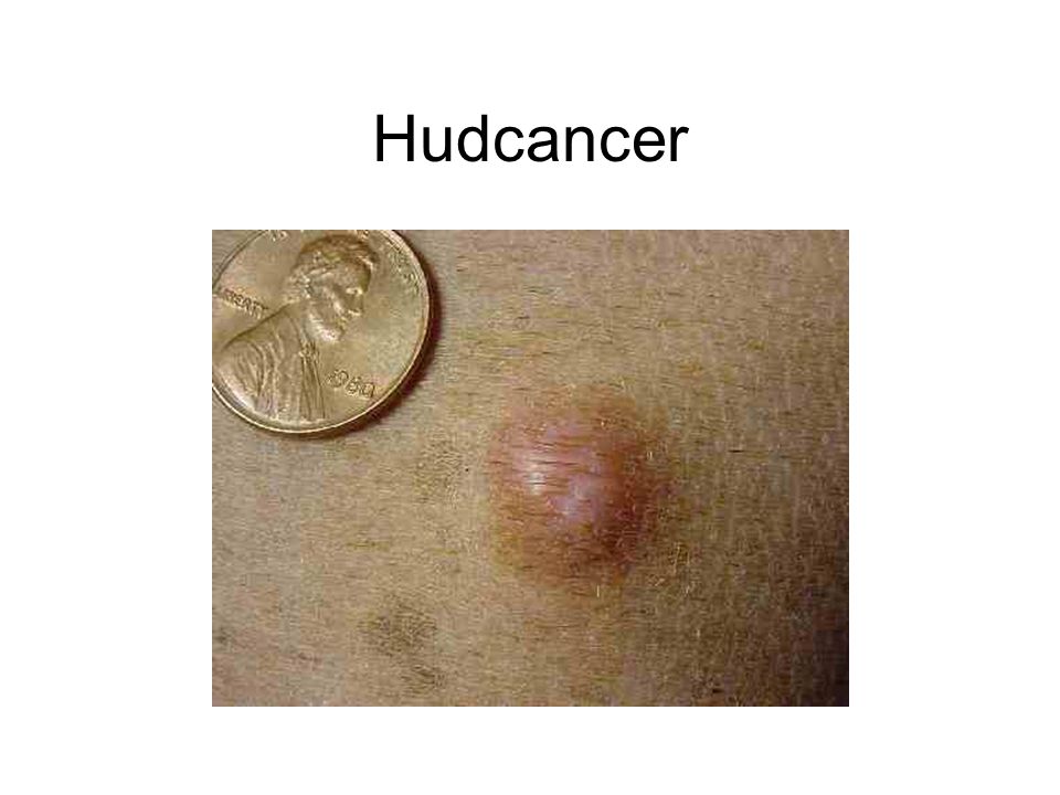 Hudcancer