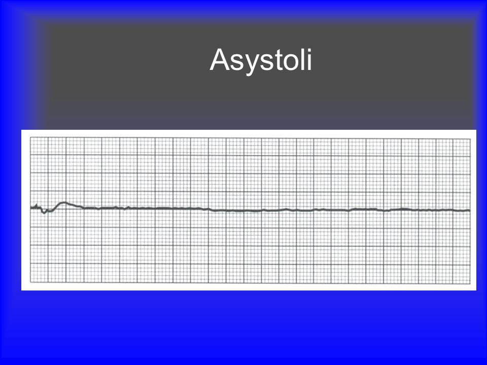 Asystoli Mention checking leads and turning up ECG gain