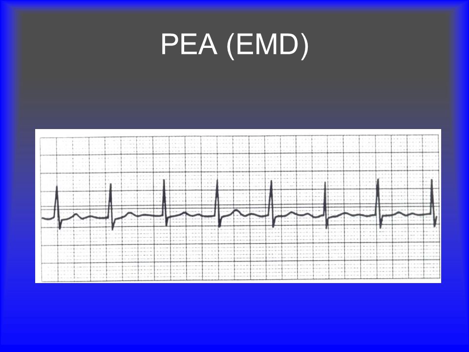 PEA (EMD) Pulseless Electrical Activity is an impalpable pulse in the presence of a rhythm that should produce a pulse.