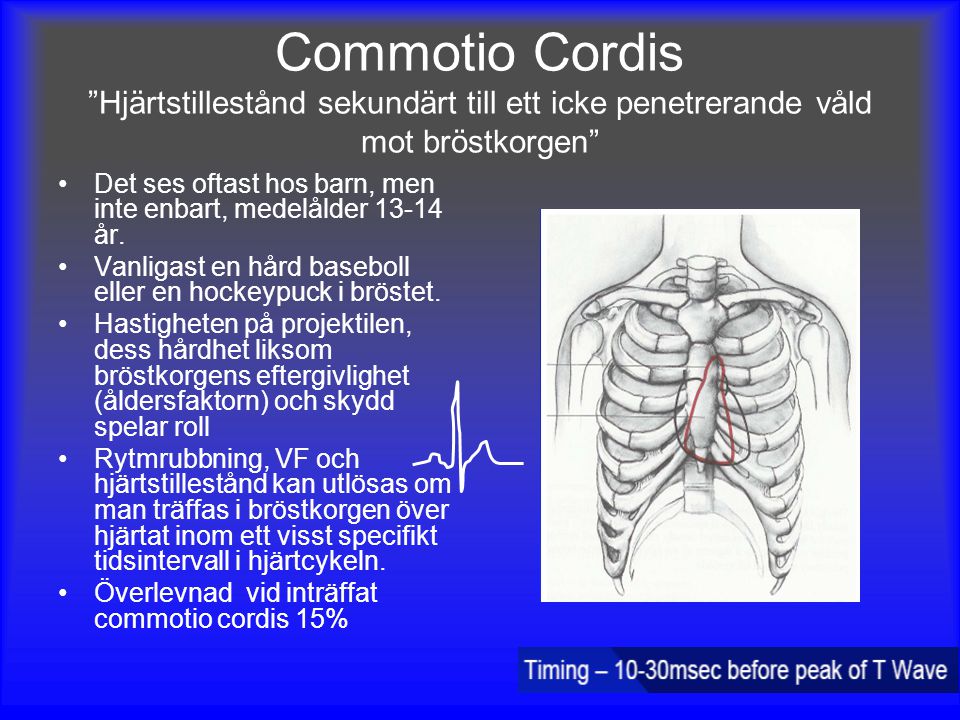 Commotio Cordis Hjärtstillestånd sekundärt till ett icke penetrerande våld mot bröstkorgen