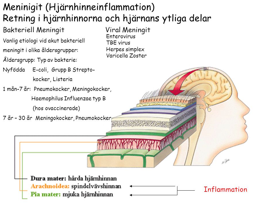 Meninigit (Hjärnhinneinflammation)
