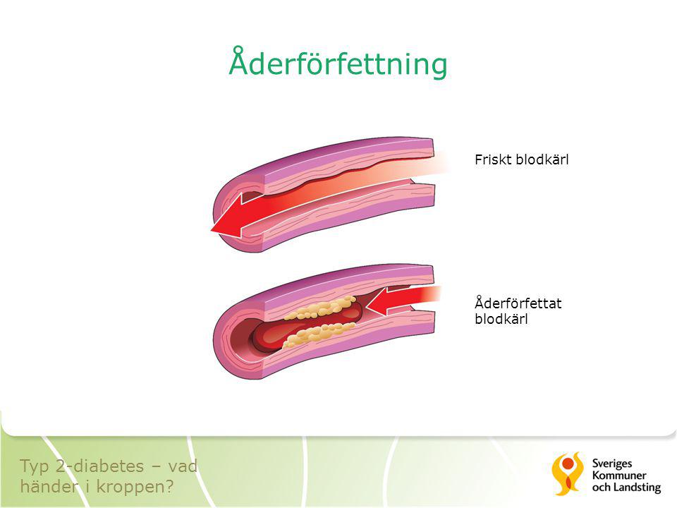 Åderförfettning Typ 2-diabetes – vad händer i kroppen Friskt blodkärl