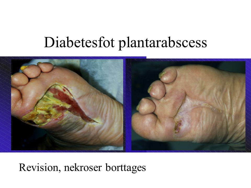Diabetesfot plantarabscess