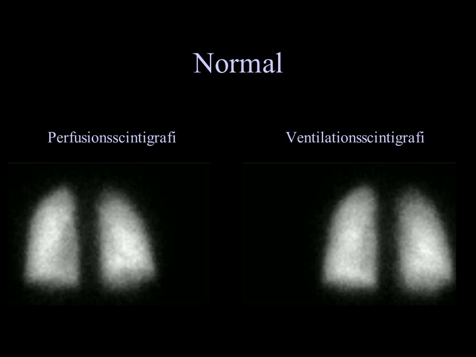 Normal Perfusionsscintigrafi Ventilationsscintigrafi