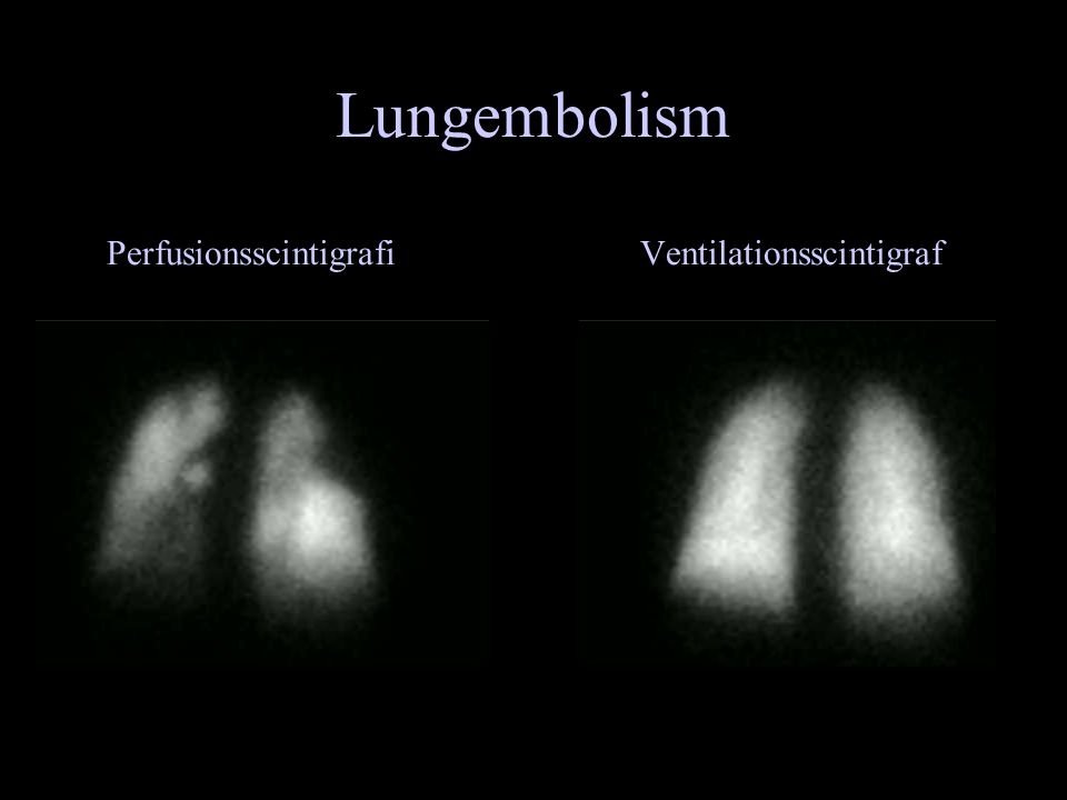 Lungembolism Perfusionsscintigrafi Ventilationsscintigraf