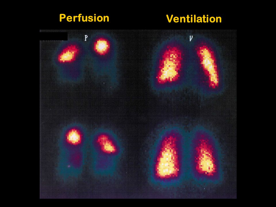 Perfusion Ventilation