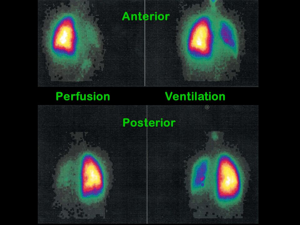 Anterior Perfusion Ventilation Posterior