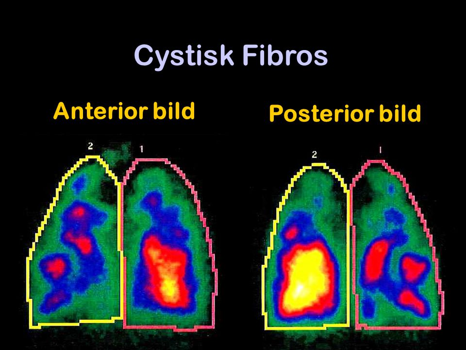 Cystisk Fibros Anterior bild Posterior bild